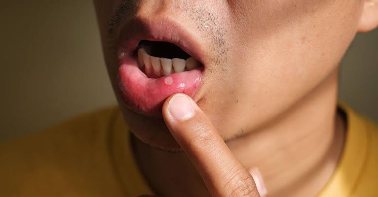 Mouth Ulcers: 4 Home Remedies To Treat Sore In The Mouth