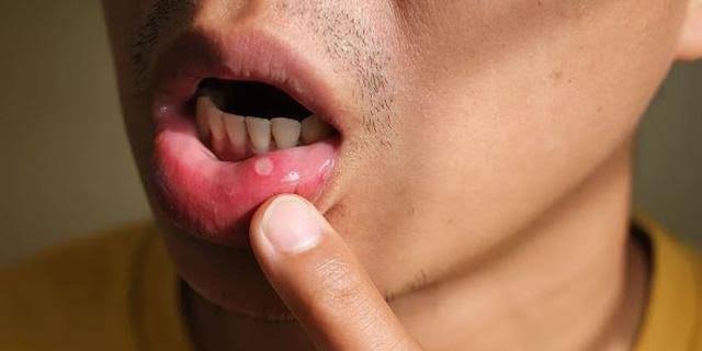 Mouth Ulcers: 4 Home Remedies To Treat Sore In The Mouth