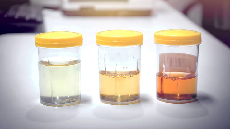 Here’s What Your Urine Colour Means To Your Health, 5 Ways To Put It In Check